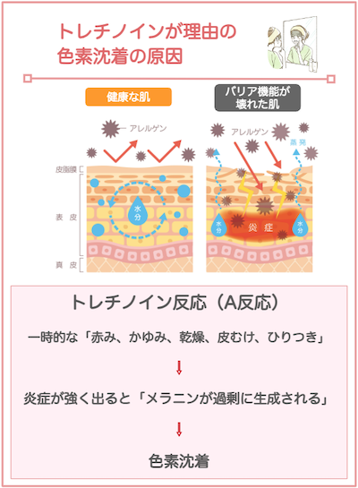 トレチノインが原因の色素沈着