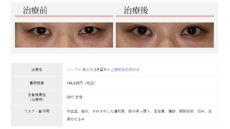 セイコメディカルビューティクリニック埋没症例