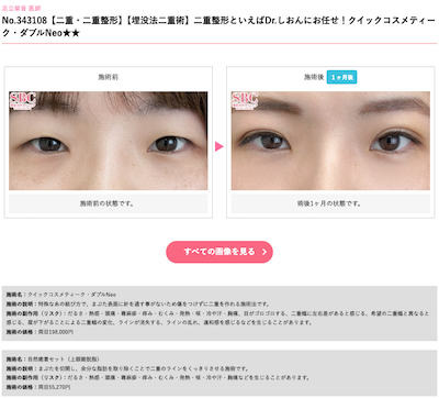sbc-二重整形-コスメティーク症例