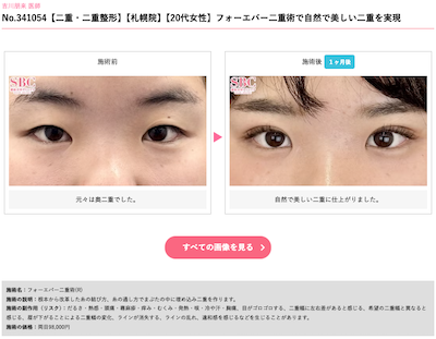 sbc-二重整形-フォーエバー症例