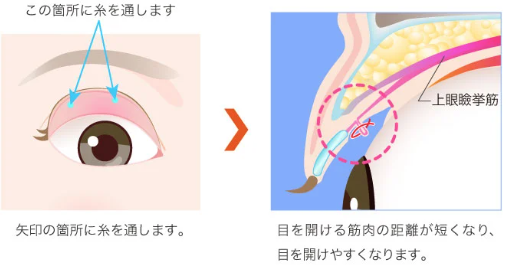 挙筋前転法（クイックデカ目術）