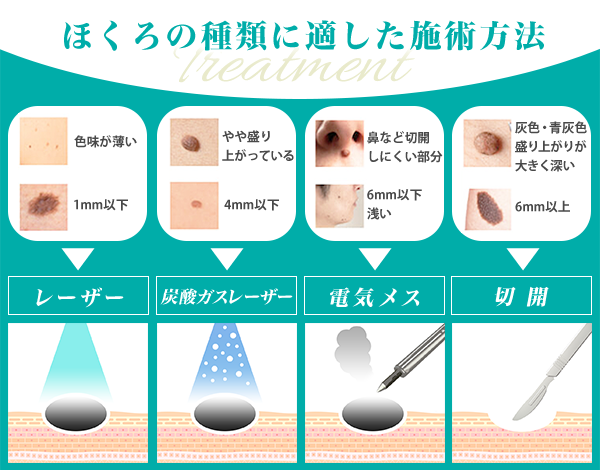 ほくろの種類に適した施術