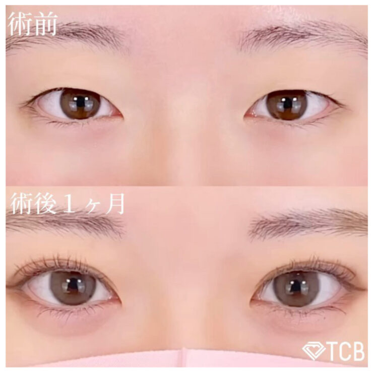 TCB二重埋没法症例