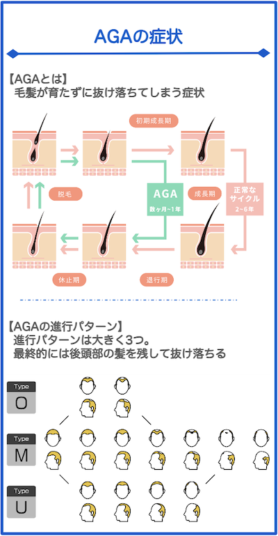 AGAとは、AGAの症状と進行