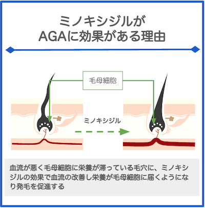 ミノキシジルがAGAに効果がある理由