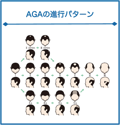 AGA進行パターン