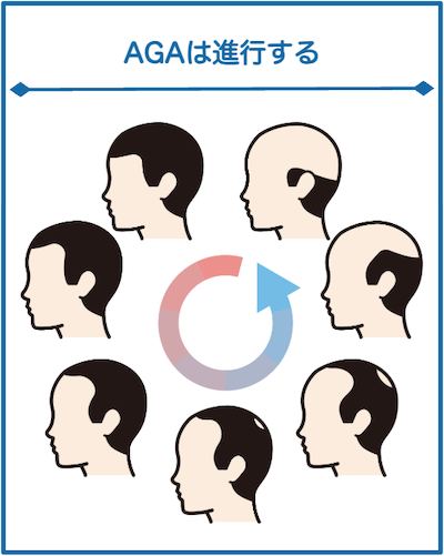 AGAは進行する