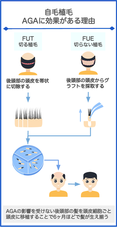 自毛植毛効果