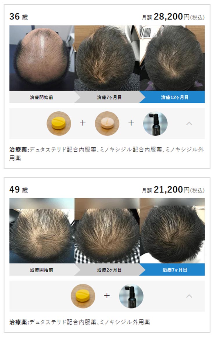 AGAヘアクリニック症例