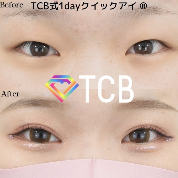 TCB二重埋没法症例