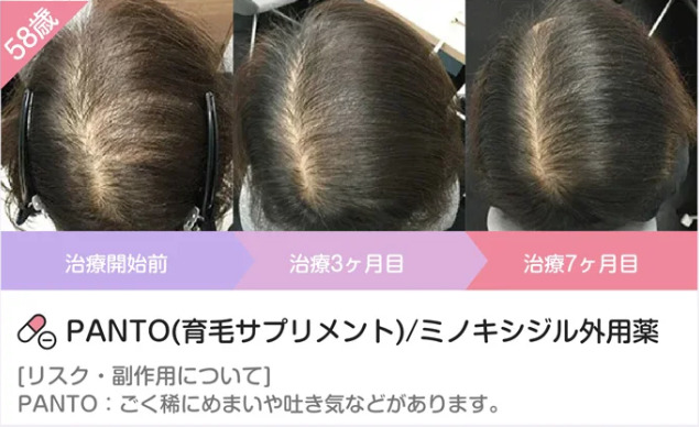 AGAヘアクリニックレディース症例