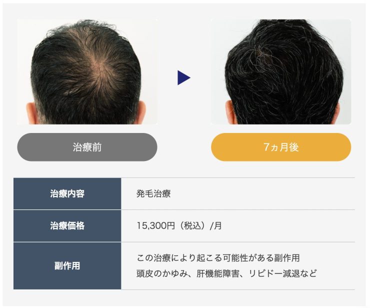 発毛プランでの症例