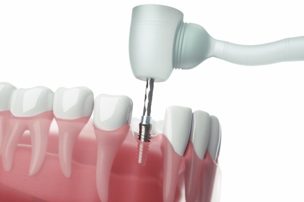 前歯のインプラント治療で気を付けるべきこと