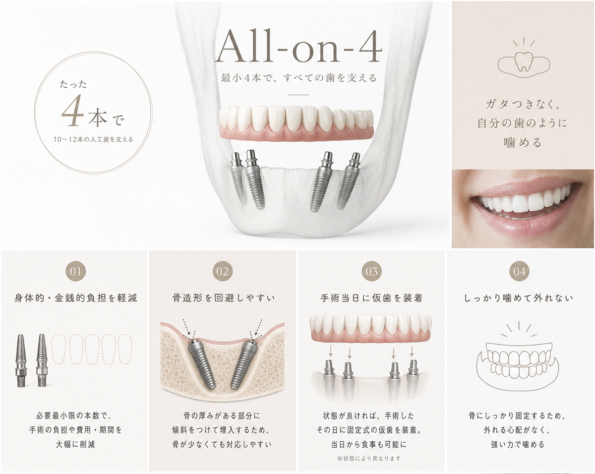 オールオン4とは