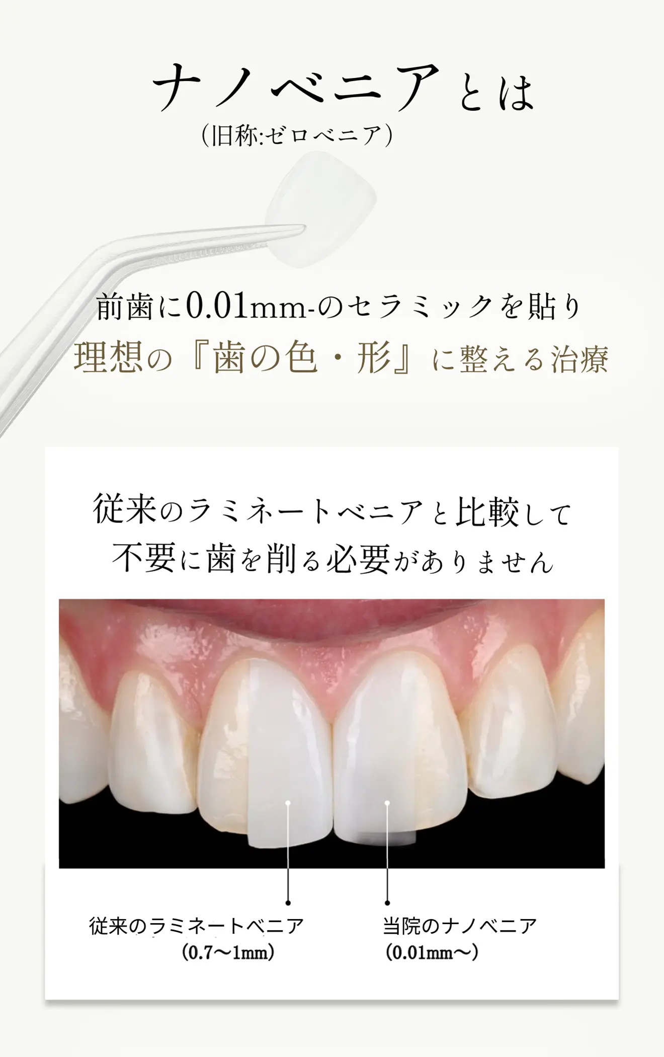 歯を削らないラミネートベニア