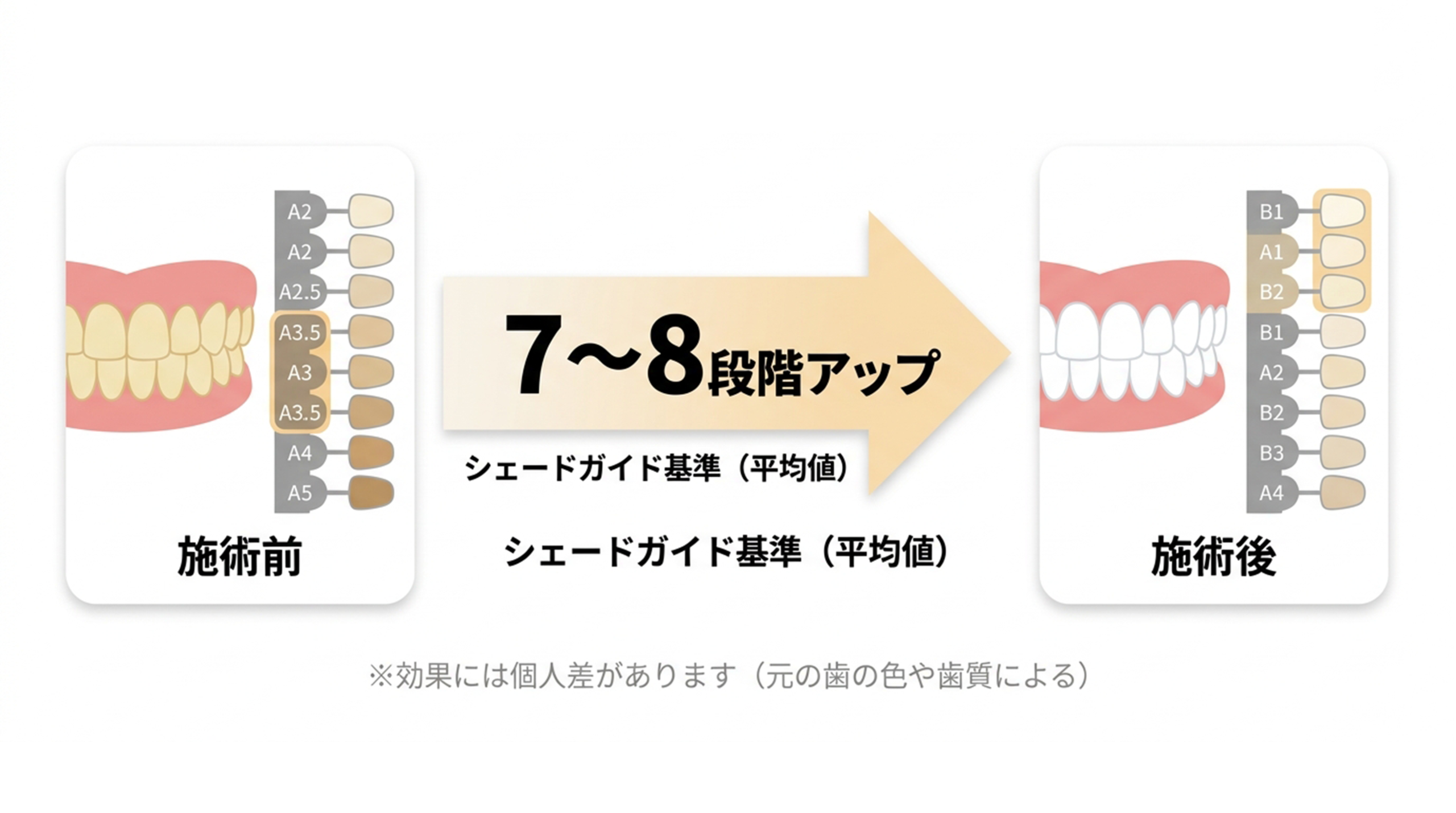 ホワイトニングのシェードガイドによる変化イメージ