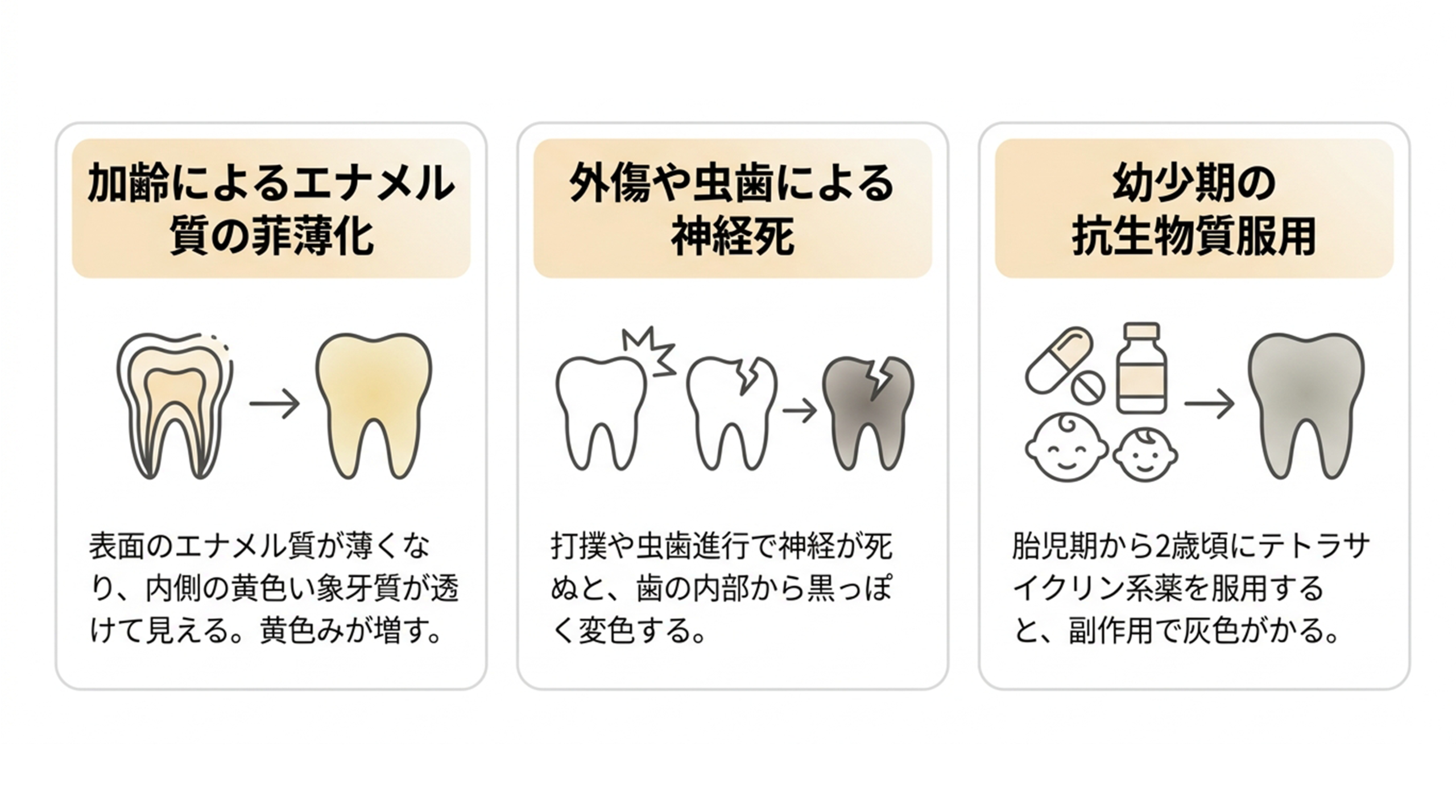 内因性変色の3つの原因（加ネル質の菲薄化・神経死・抗生物質服用）