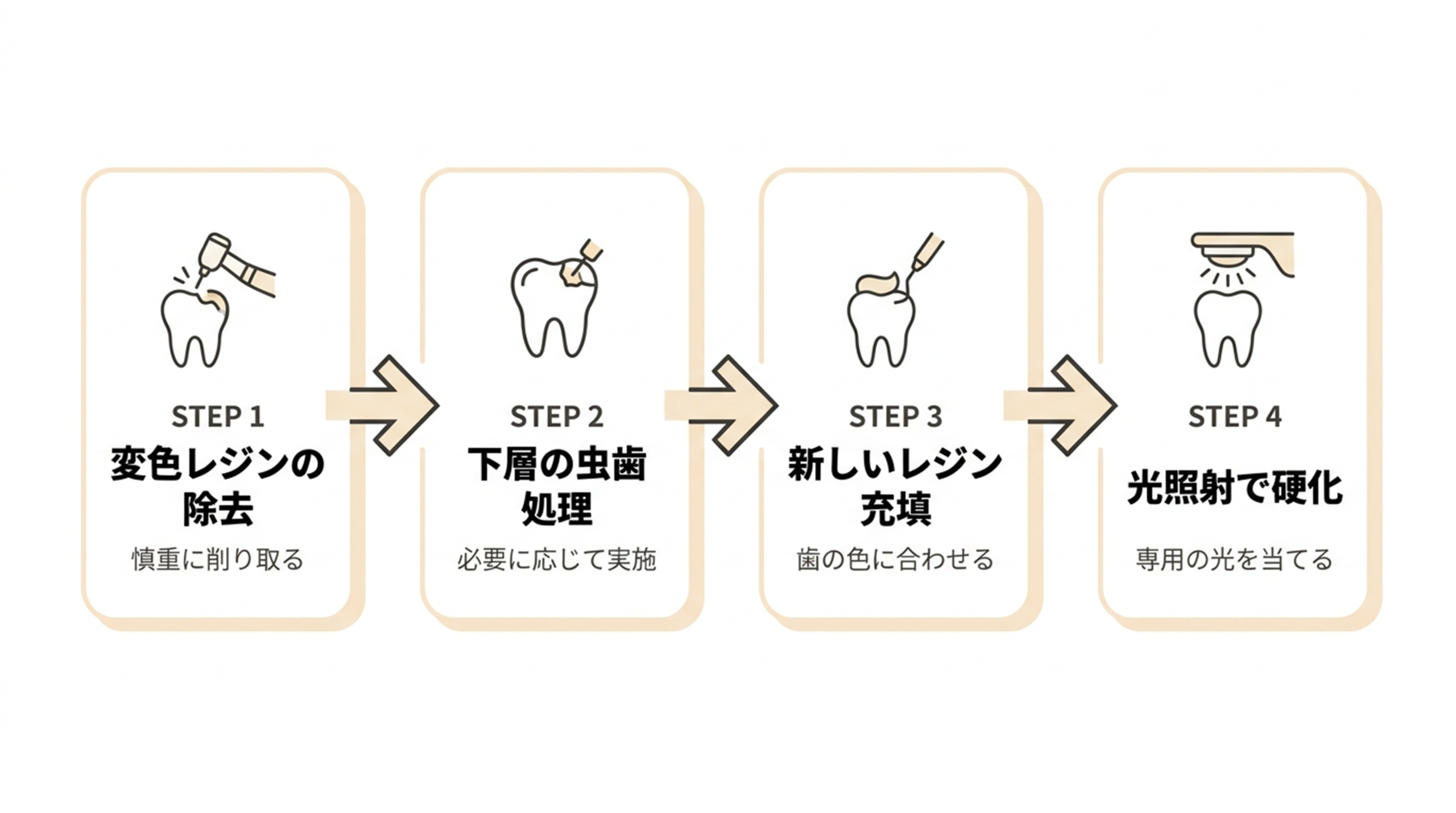 コンポジットレジン充填の治療ステップ